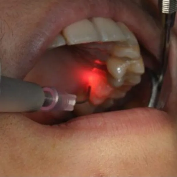 Laser Dentistry in Mulund West Mumbai: Cost, Procedure & Recovery Time Explained