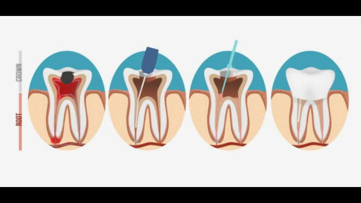 Root canal treatment near swargate pune