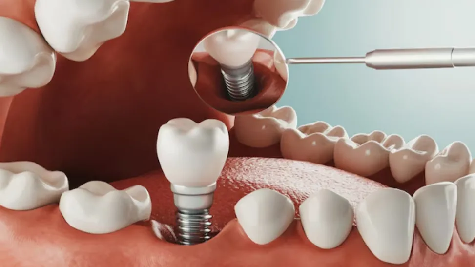 Permanent Teeth Replacement Solutions in Delhi – Long-Term Dental Stability