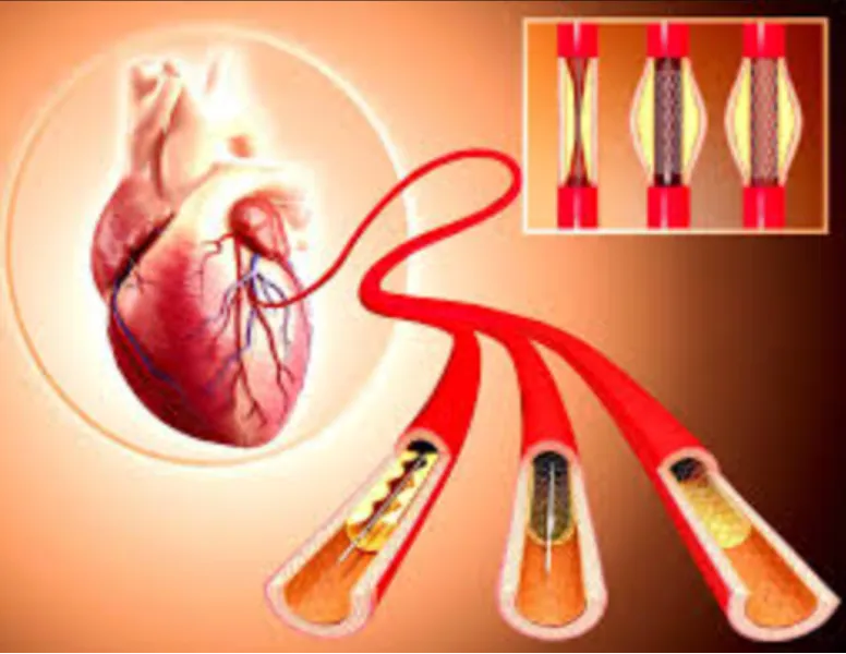 Angiography in Vashi: A Vital Step in Heart Health