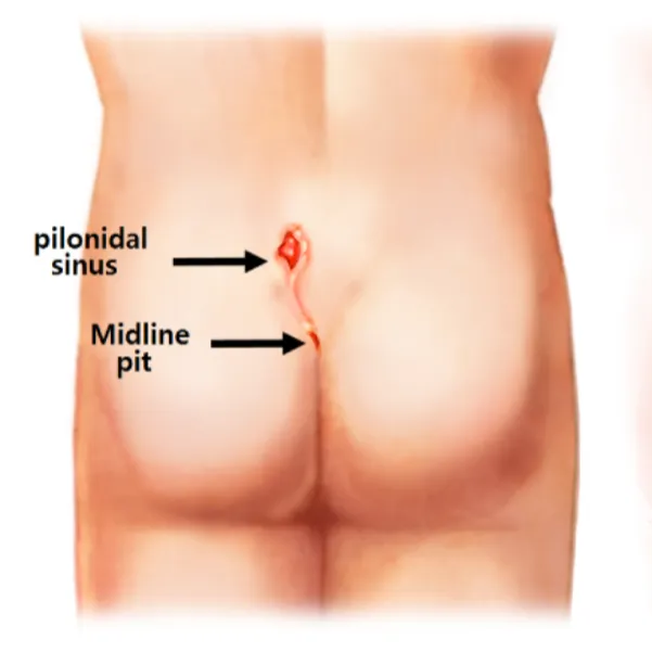 Pilonidal Sinus surgery in Thane | Advanced Care for Long Term Comfort
