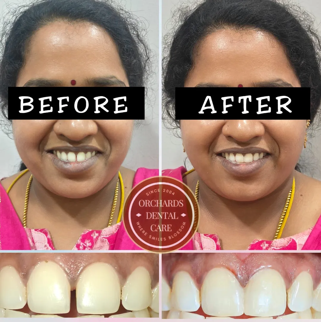 Close Teeth Gaps in One Visit – Book Your Consultation Today!
Call or WhatsApp: +91 80880 51253
✨
...