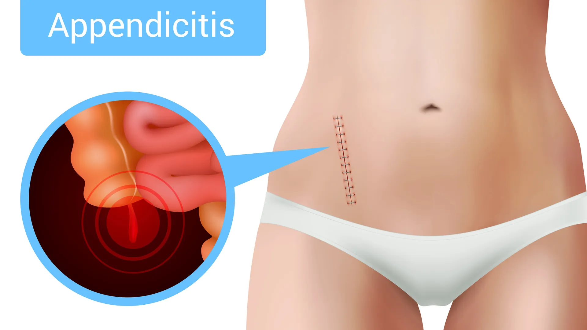 Appendicitis and Appendix Surgeon in Sion – Timely Treatment for Acute Abdominal Pain