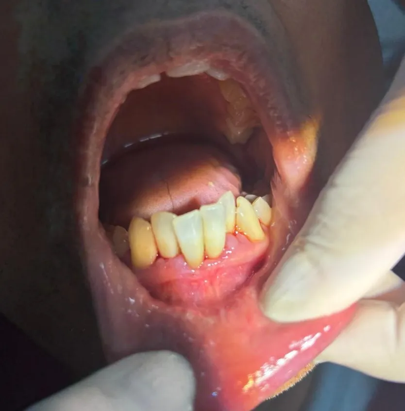 Gum Treatment in Mulund West Mumbai: Cost, Procedure & Recovery Time Explained