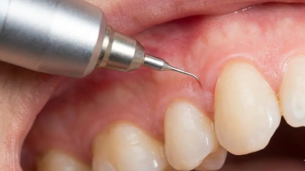 Is Laser Dentistry Painful? Dentist in Thane (Nitin Company Area) Explains the Truth