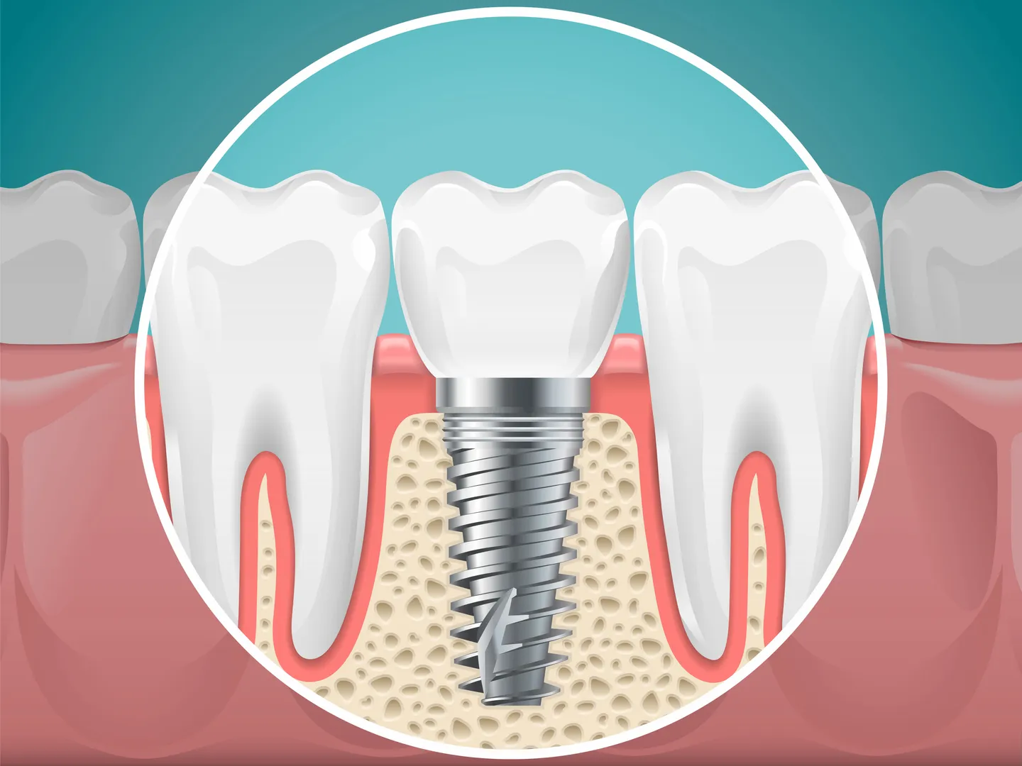 Dental Implants in Hebbal – A Reliable Way to Restore Missing Teeth