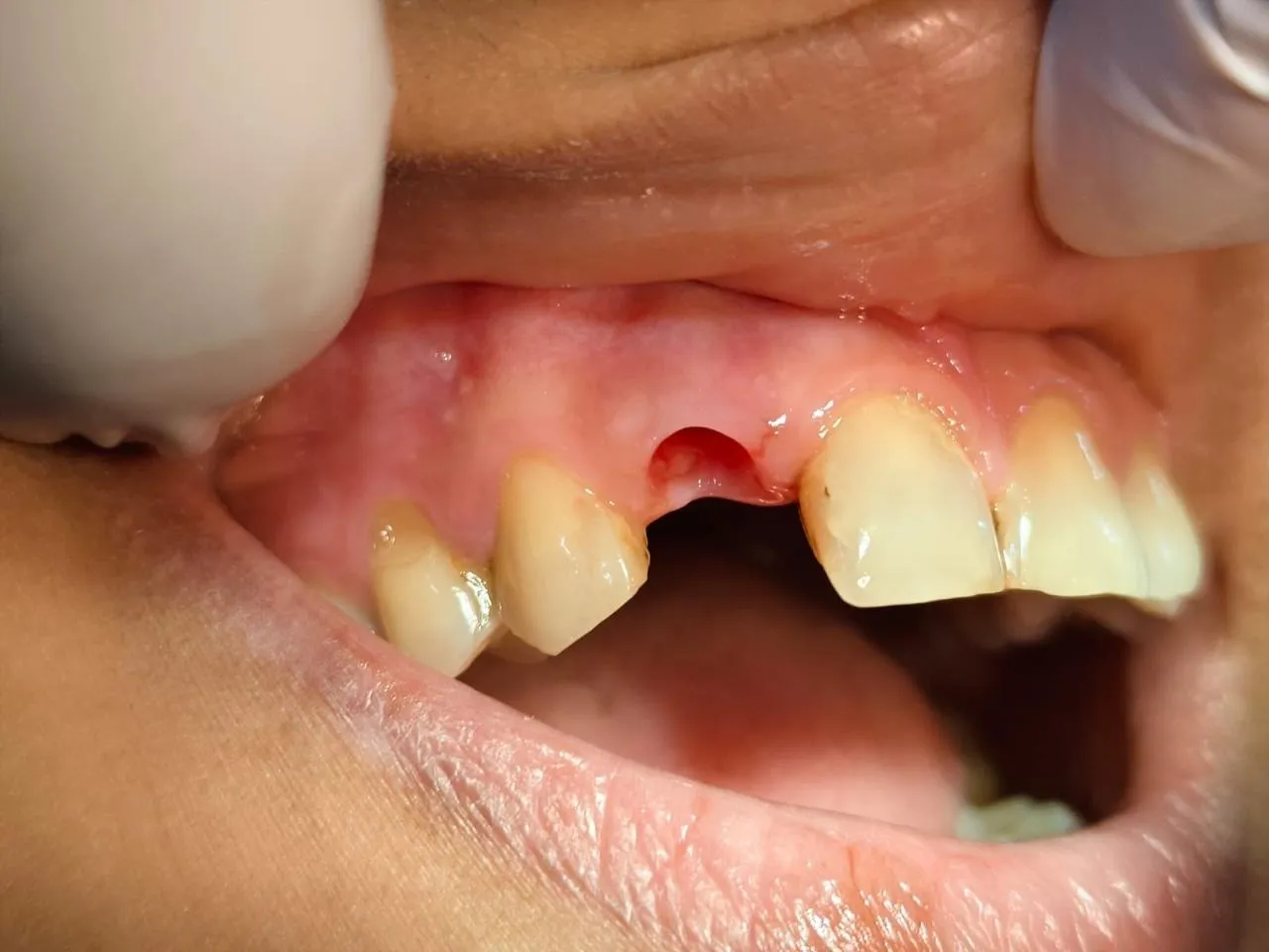 Is Tooth Extraction Painful? Dentist in Mulund West Mumbai Explains the Truth