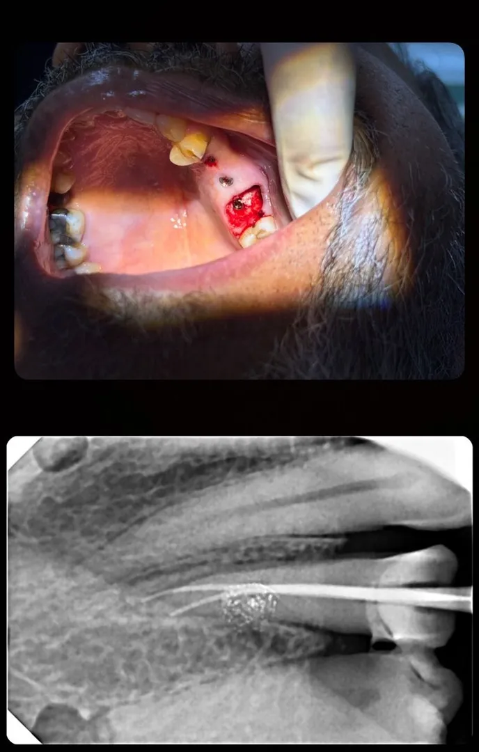 Tooth Extraction vs Alternatives: What Dentists in Thane (Nitin Company Area) Recommend