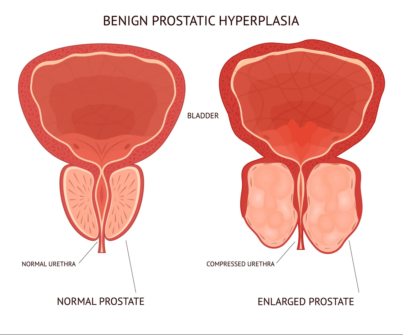 Benign Prostatic Hypertrophy Treatment in Thane West for Lasting Urinary Relief