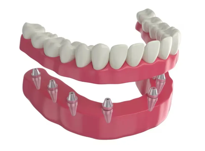 Advanced Implant Supported Dentures in Delhi – Stable and Long-Lasting Tooth Replacement