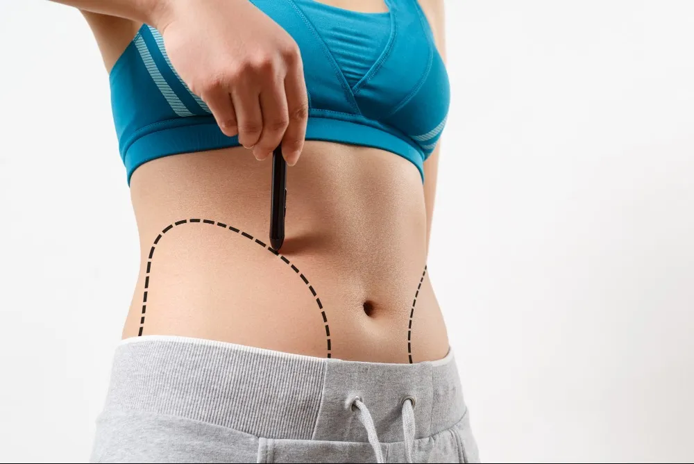 Liposuction Surgery in Bengaluru – Target Stubborn Fat with Precision
