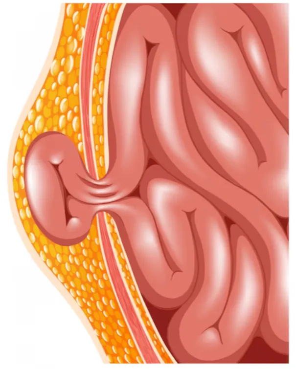 Laparoscopic Hernia Repair Surgery in Byculla – Minimally Invasive Treatment for Hernia Problems