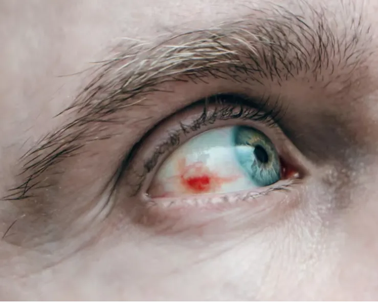 Emergency Eye Care and Ocular Trauma Treatment in Masjid Bunder