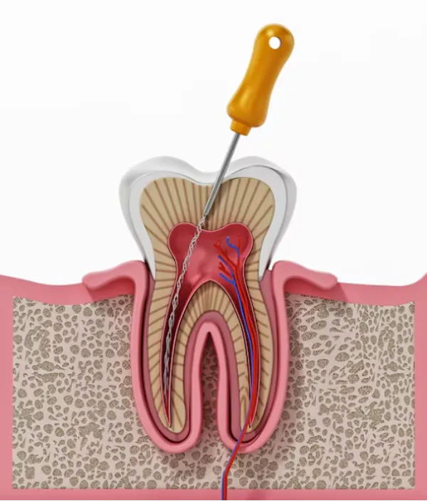 Root Canal Treatment in Sarjapur Road – Understanding Relief from Persistent Tooth Pain