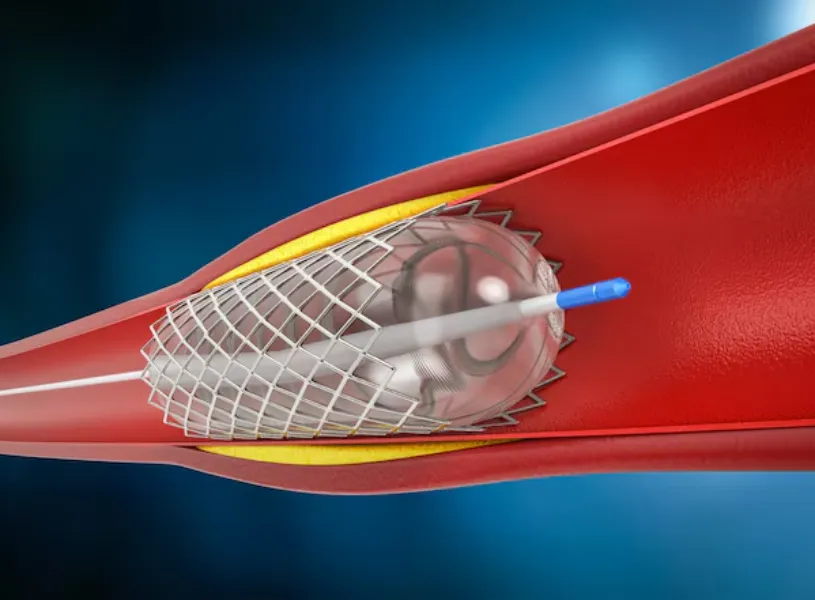 Angioplasty (PTCA) in Vashi: A Lifesaving Heart Procedure