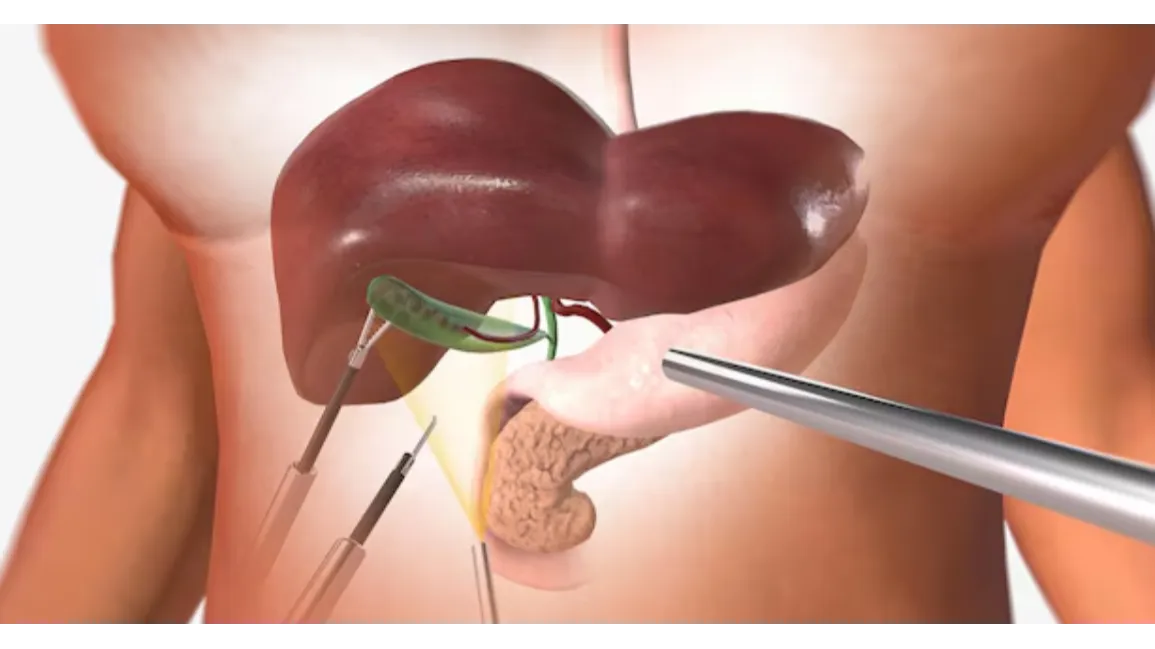 Gall Bladder Stone Surgery in Goregaon – A Safe and Modern Approach