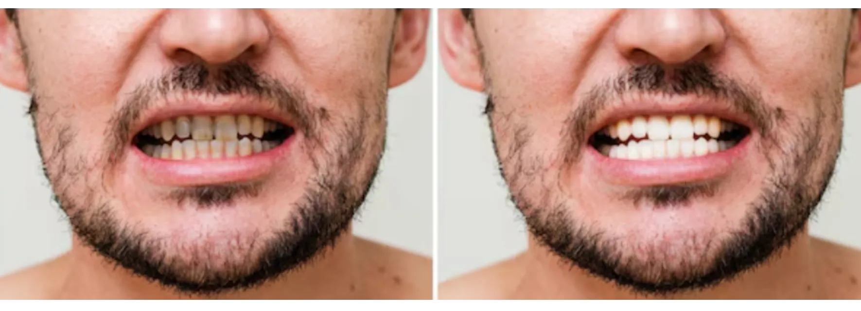 Full Mouth Rehabilitation in Ganganagar – Restoring Comfort and Bite Balance