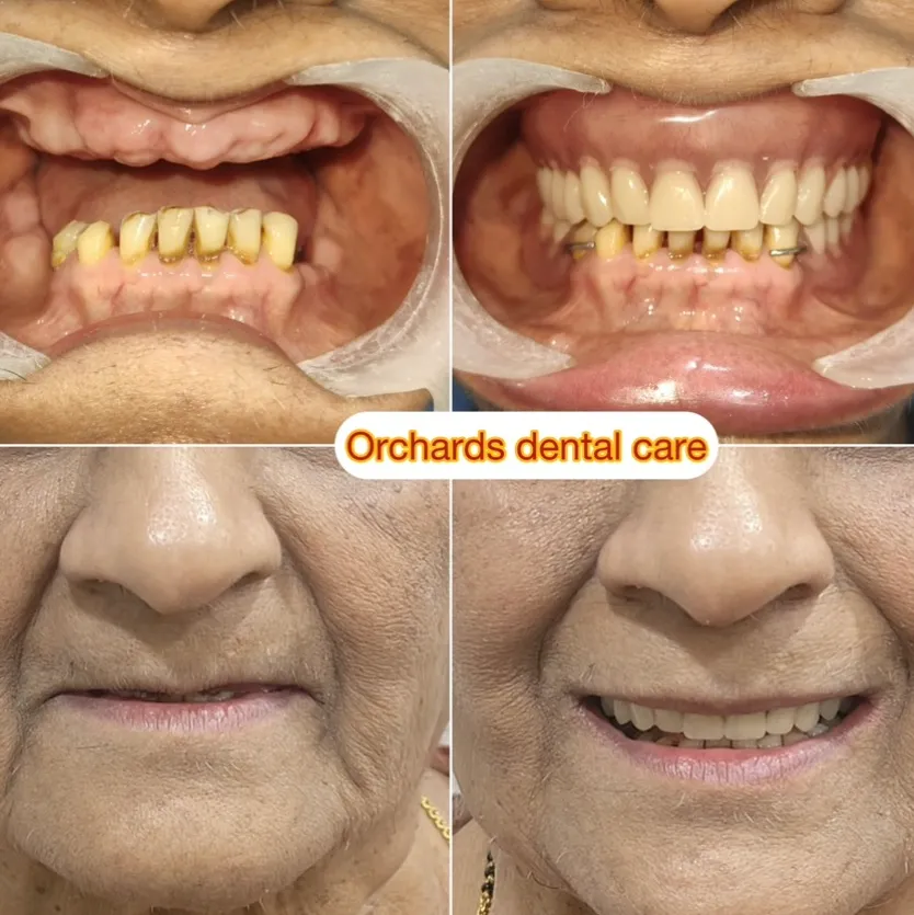 Complete dentures in Bangalore Sadashivanagar
