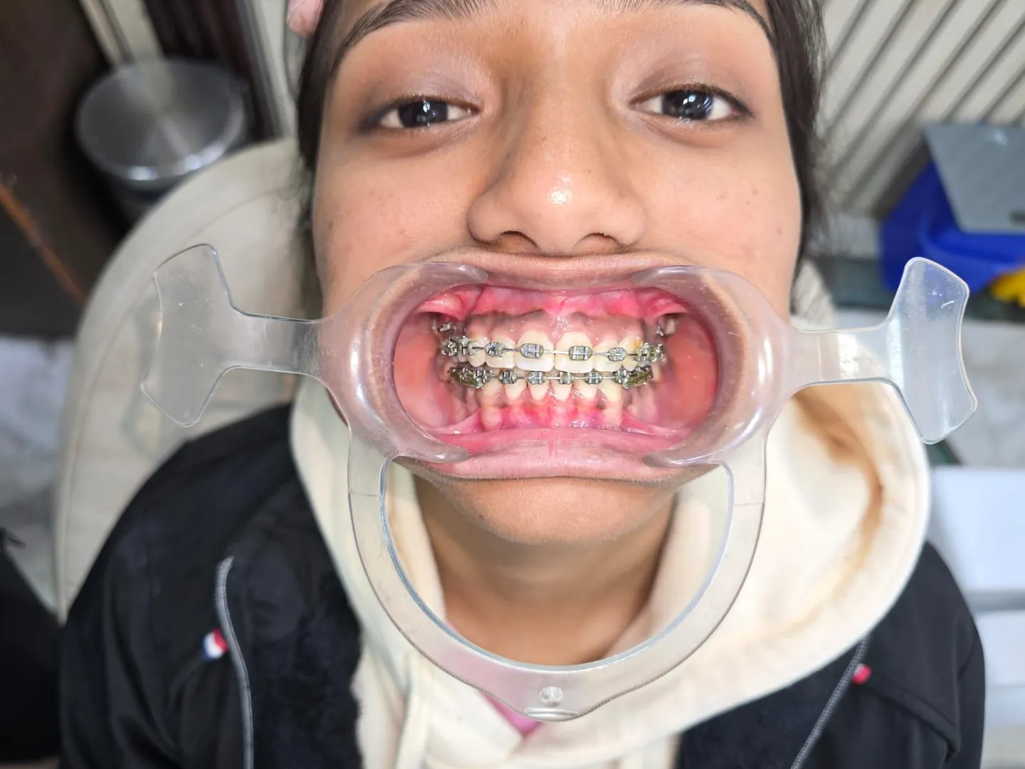 Orthodontic Treatment in Gaur City | Braces & Aligners – P.D. Dental Clinic