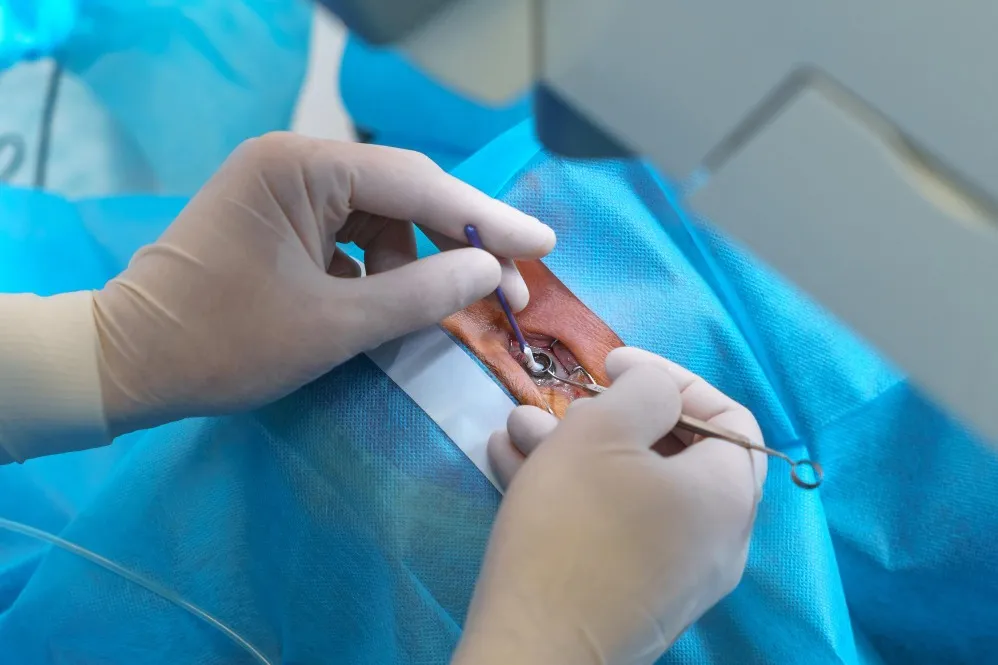 Best Eye Surgery in Mohali for Condition-Specific Surgical Intervention