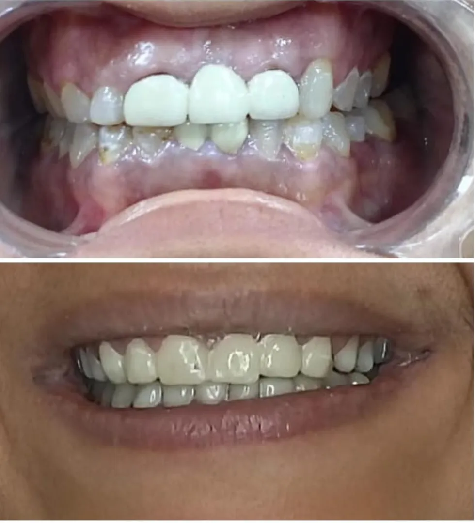 How Much Does Dental Veneers Cost in Thane (Nitin Company Area)? A Complete Patient Guide