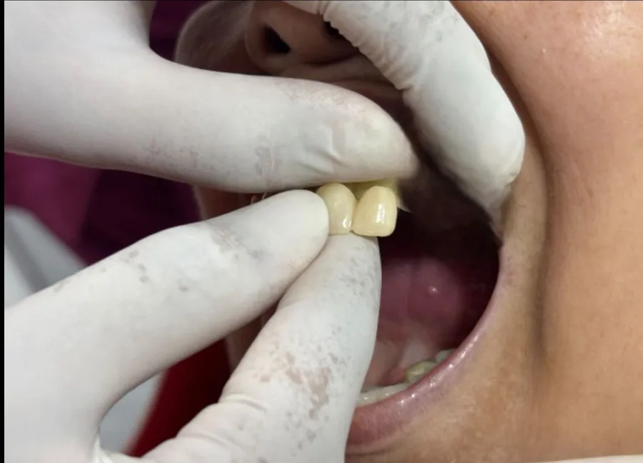 Dental Crowns in Thane (Nitin Company Area): Before, During & After Treatment Guide