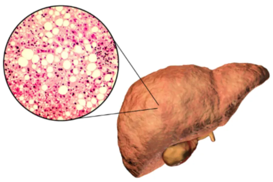 Early Hepatic Encephalopathy Detection Mumbai – Recognizing Subtle Warning Signs