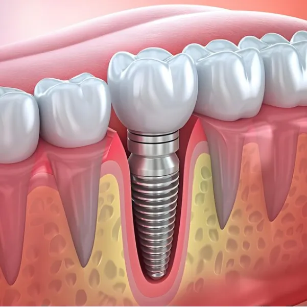 Single Tooth Implant Specialist Dwarka – Precision-Based Tooth Restoration