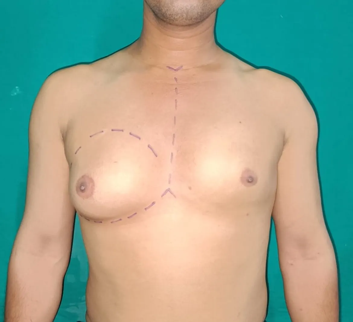 Best Gynecomastia treatment by liposuction - Scarless