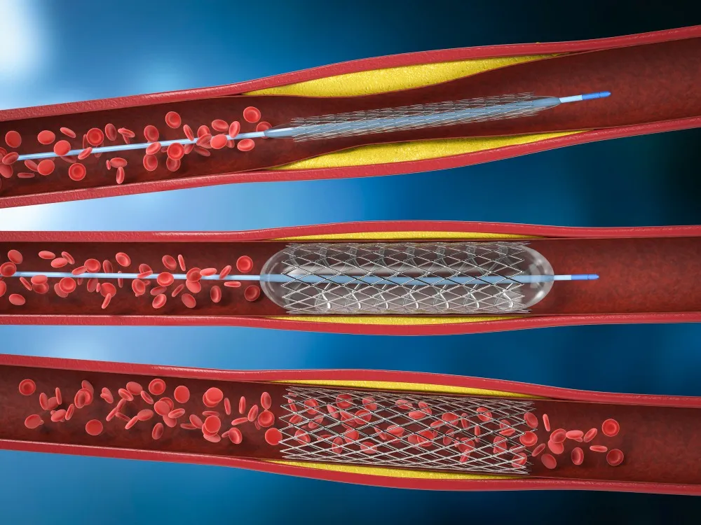 Angioplasty Treatment in Bangalore for Blocked Arteries