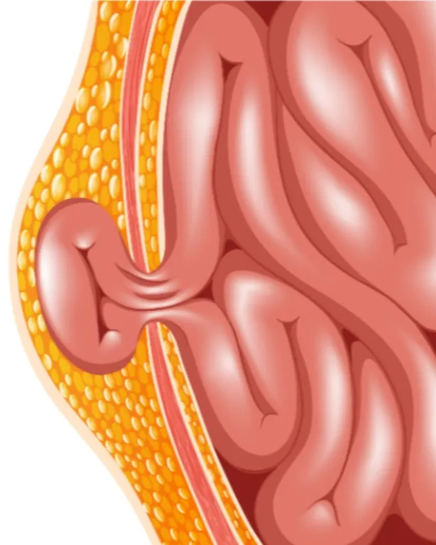 Hernia Treatment in Hinjewadi – Identifying the Problem Before It Worsens