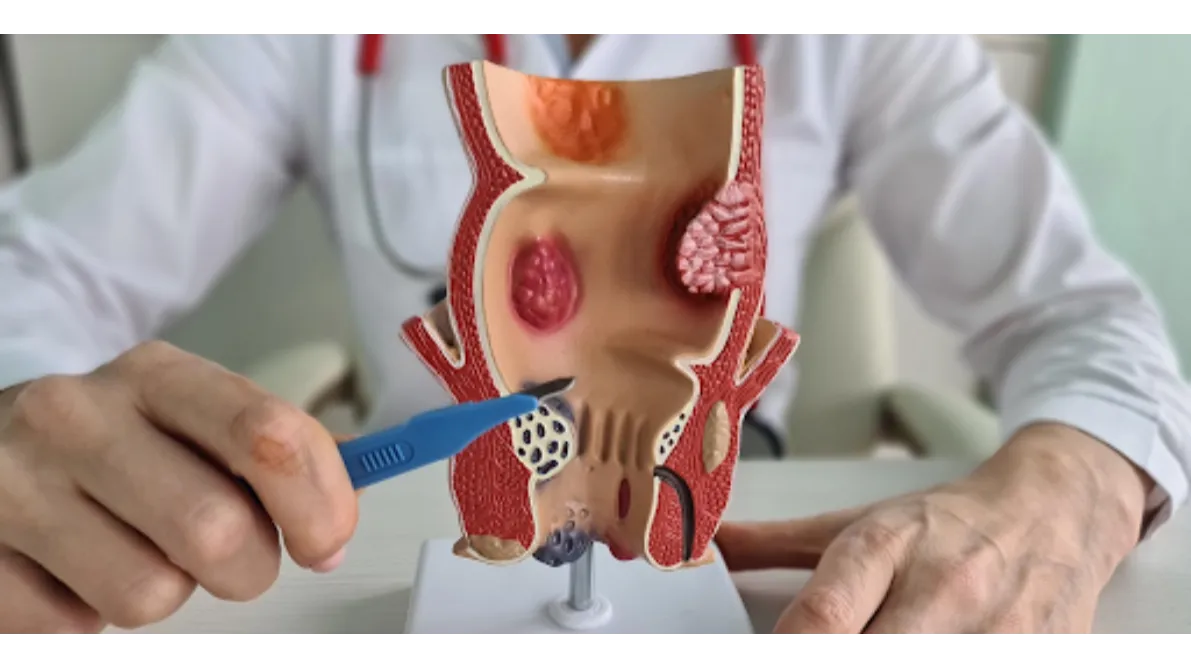 Piles Specialist in Kharadi - When Should You See a Doctor?