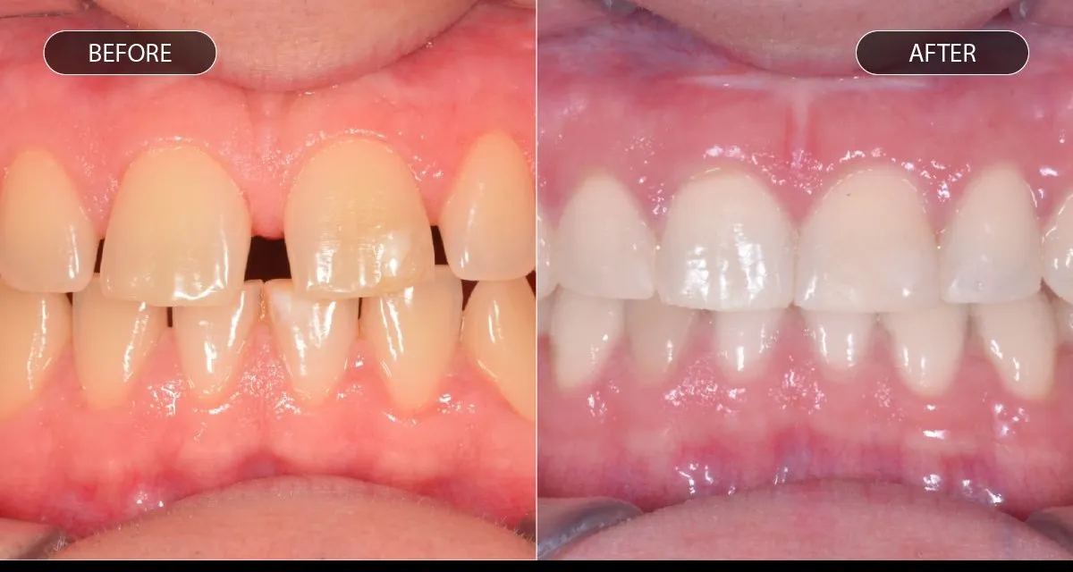 Many people think orthodontic treatment is only for teenagers. However, adults are increasingly choo