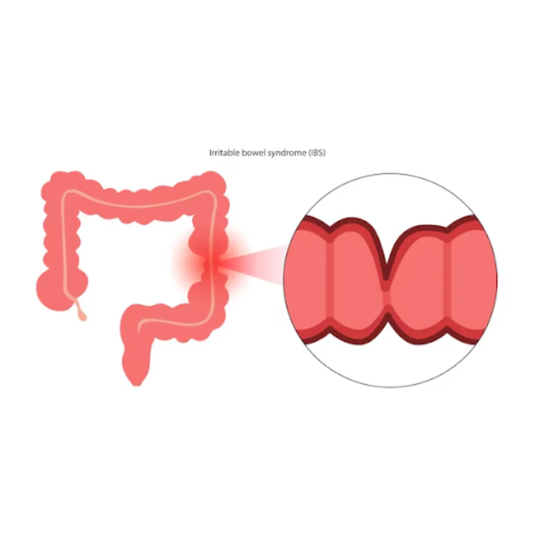 Irritable Bowel Syndrome (IBS) Treatment in Mumbai – Improving Everyday Digestive Comfort