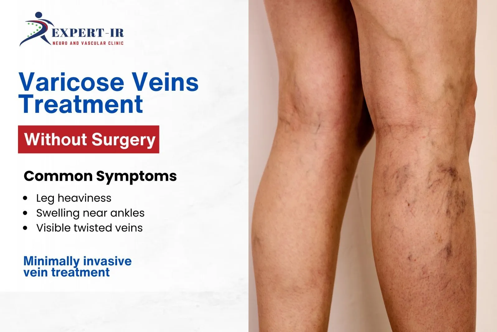 best Varicose Veins Treatment Without surgery in pune