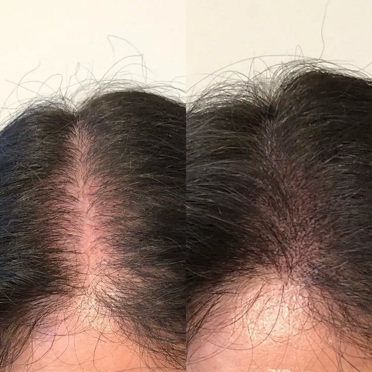 hair restoration nashik
GFC treatment nashik
exosomes therapy
hair skin PRP treatment