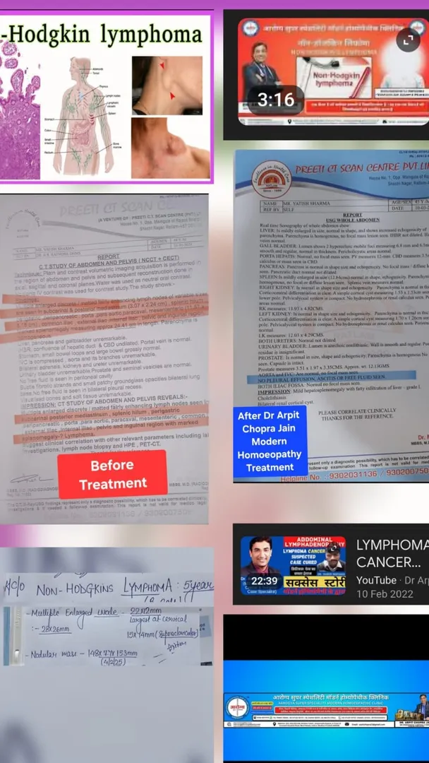 Non Hodgkins Lymphoma B Type 11.57 x 6.18 CM Lesion qith metastasis dissolved by help of Homeopathy...