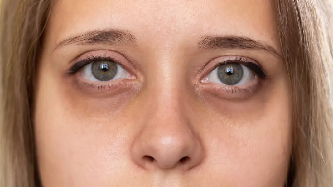 Under-Eye Dark Circle Treatment in Alwarpet – Brighter, Refreshed Appearance