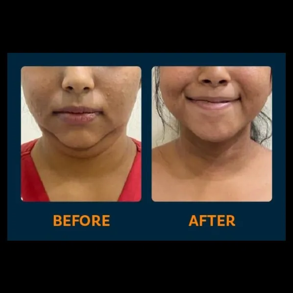 Double chin reduction treatment In Vashi