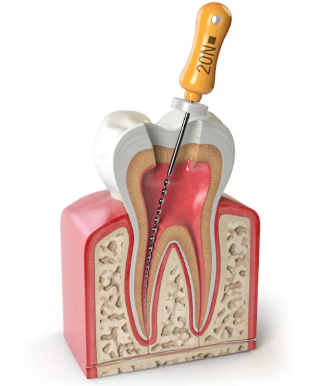 Pain-Free RCT Specialist in Dwarka – Comfortable Root Canal Care
