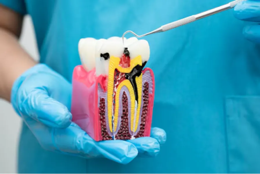 Root Canal Treatment in Munnireddypalya - Protecting Natural Teeth from Infection