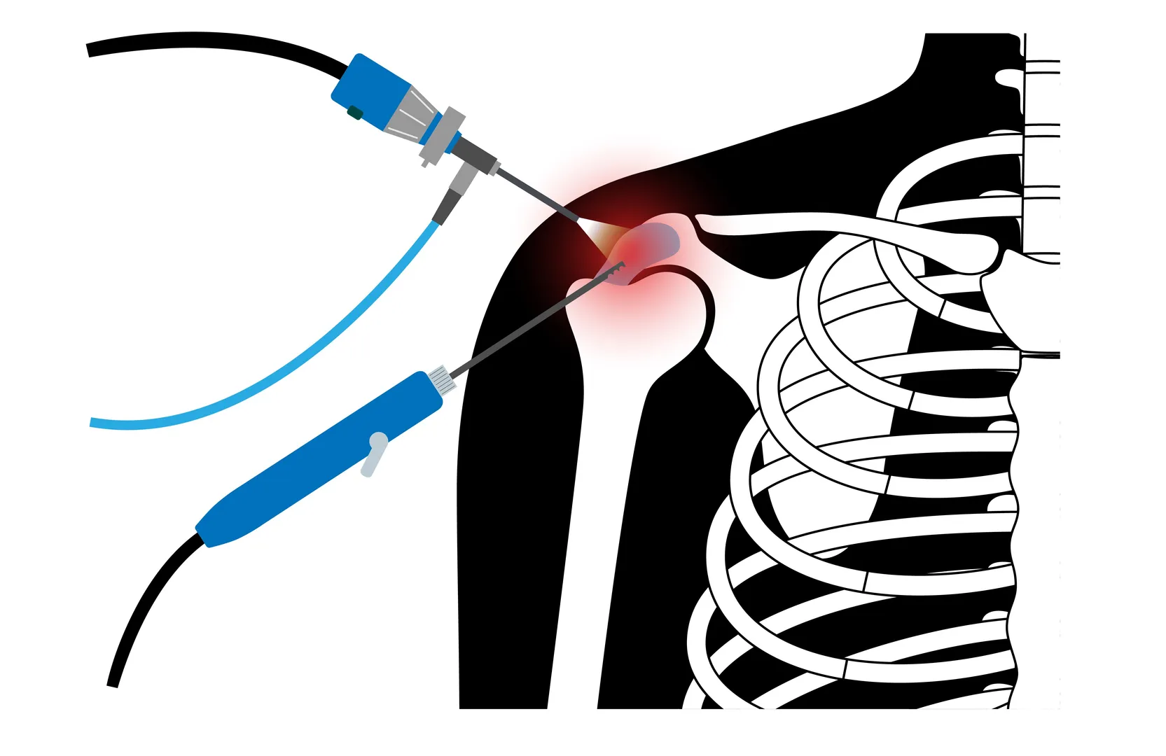 Minimally Invasive Shoulder Surgery in Parel - Faster Recovery with Targeted Care