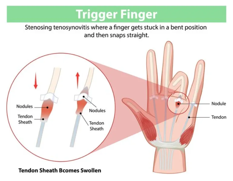 Trigger Finger Treatment in Chembur – Restoring Smooth Finger Movement