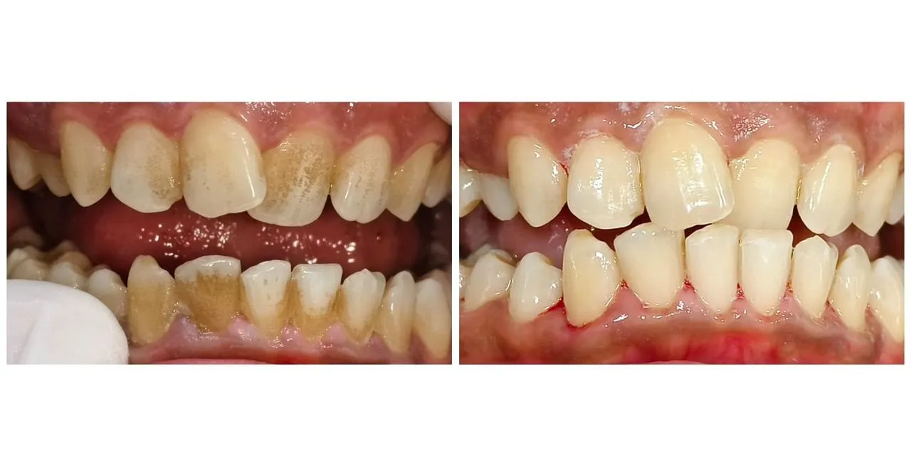 Laser Dentistry vs Alternatives: What Dentists in Mulund West Mumbai Recommend