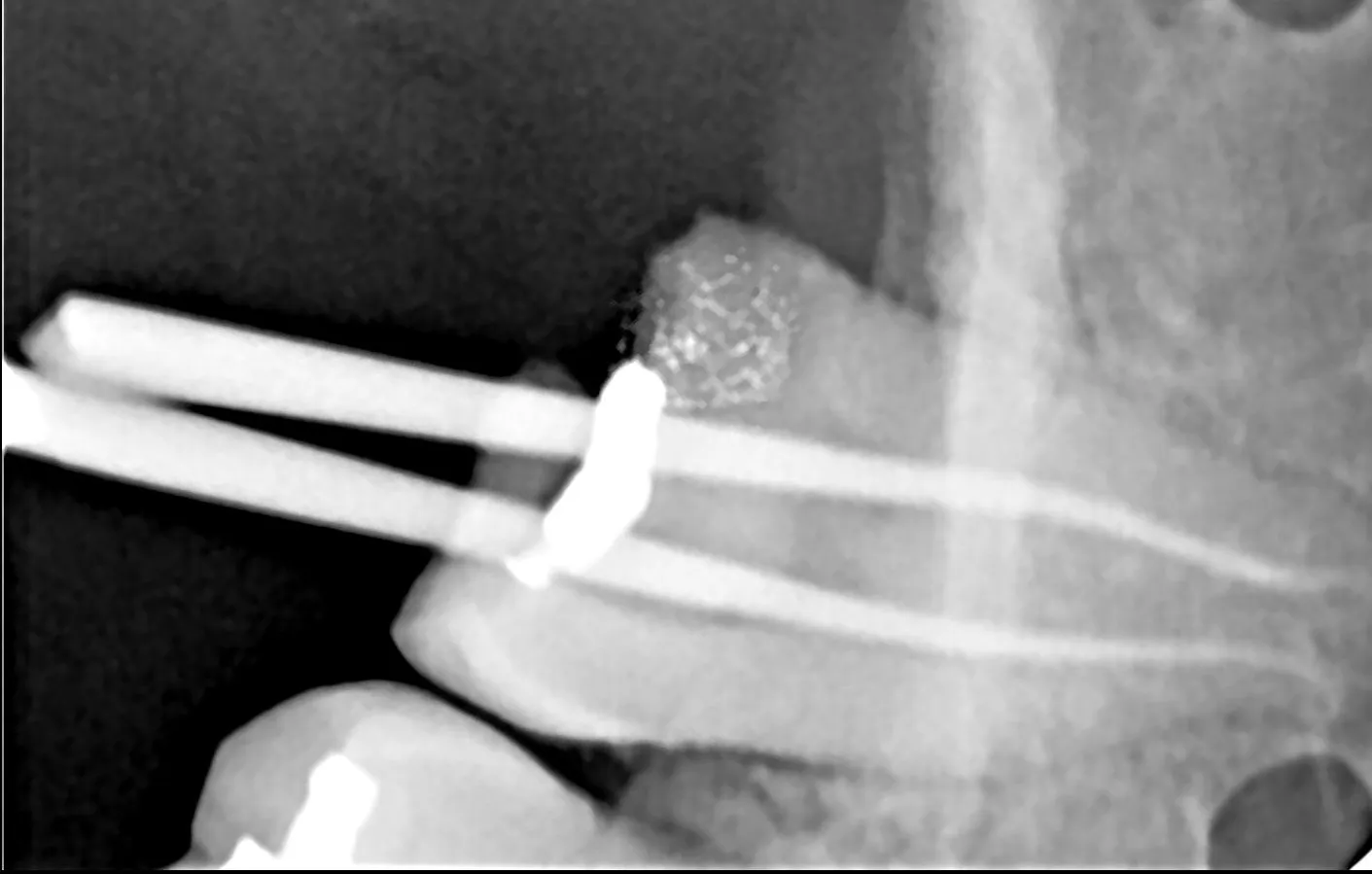 How Long Does Root Canal Treatment Take? Timeline Explained by Dentists in Mulund West Mumbai