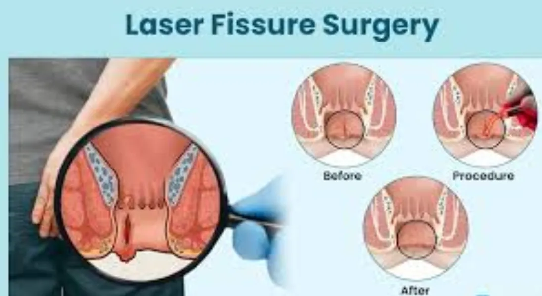 Fissure Treatment in Goregaon – Managing Pain with the Right Approach