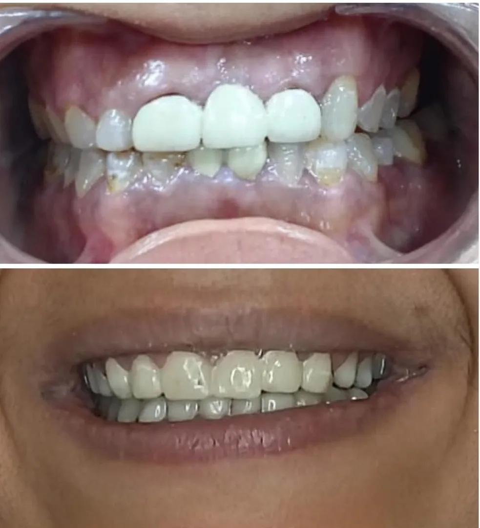 How Long Does Dental Veneers Take? Timeline Explained by Dentists in Mulund West Mumbai
