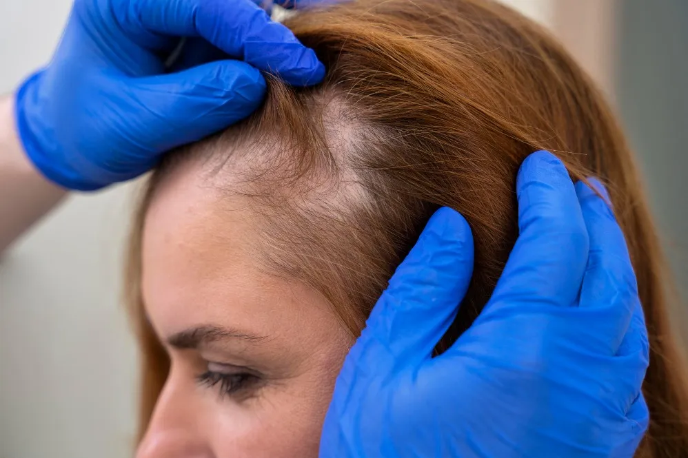 Hair Loss Treatment in Pune - Effective Solutions for Hair Thinning