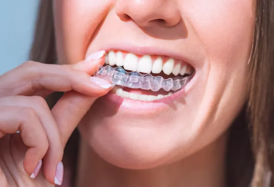 Clear Braces and Invisible Aligners in Dwarka – Discreet Orthodontic Solutions