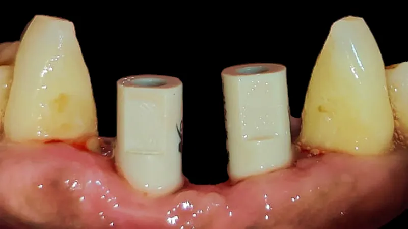 Full Mouth Rehabilitation vs Alternatives: What Dentists in Thane (Nitin Company Area) Recommend